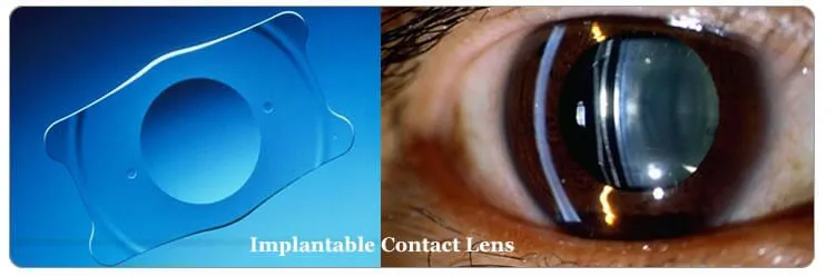 lasik- eye-surgery-implantable-contact-lens